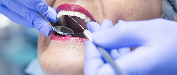 Best Emergency Wisdom Teeth Removal in Kitsap Lake, WA